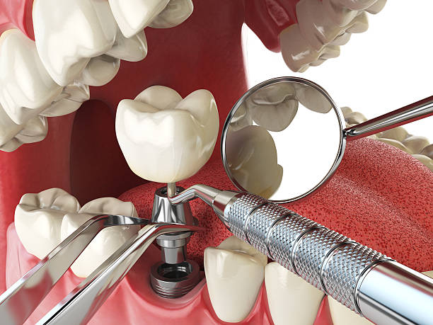 Best Emergency Root Canal Treatment in Chickamau, GA